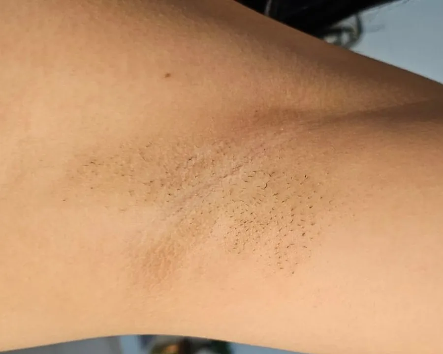 Oksel vóór laserontharing bij TheG8